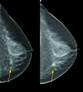 mamografia tomográfica permite detectar câncer mais facilmente